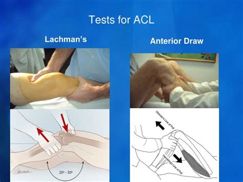 test acl tear|lachman's test vs anterior drawer.